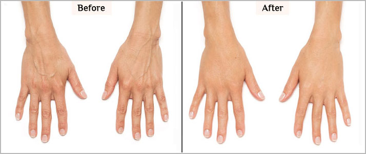 radiesse for hand rejuvenation before and after